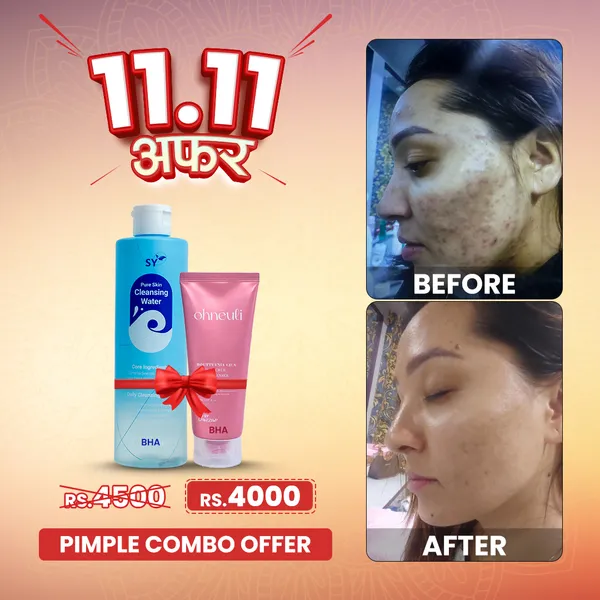 Pimple Combo of SY Pure Skin Cleansing Water 300 ML & OHNEULI Houttuynia Foam Cleanser 150 ML