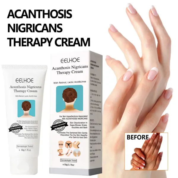 Eelhoe Acanthosis Nigricans Therapy Cream 50 GM